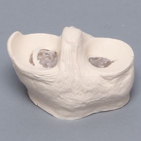 Meniscal Insert, includes Bucket-Handle Tear and Parrot-Beak Pathology