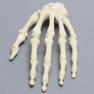 Hand with Scaphoid Fracture, Solid Foam