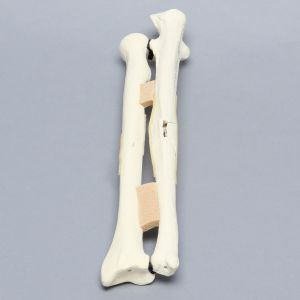 Ulna and Radius with Four-Part and Oblique Fractures, Solid Foam