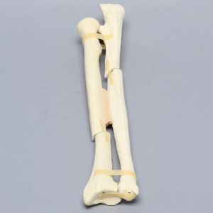 Ulna and Radius with Oblique and Transverse Fractures, Solid Foam