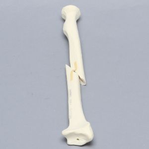 Radius with Short Oblique Fracture, 5.5mm Canal, Solid Foam