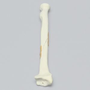 Radius with Long Oblique Fracture, 5.5mm Canal, Solid Foam