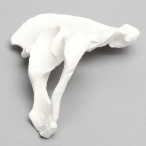 Hemi Pelvis, Female, Solid Foam, With Dysplasia, Left