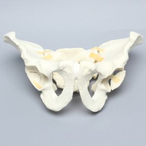 Pelvis with Disruption and Wall Fractures, Full Male, Solid Foam