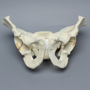 Pelvis with "T" and Both-Column Fractures, Full Male, Foam Cortical