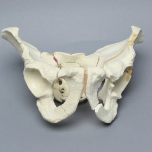 Pelvis with Sacral, Acetabular, and Column Fractures, Full Male, Foam Cortical