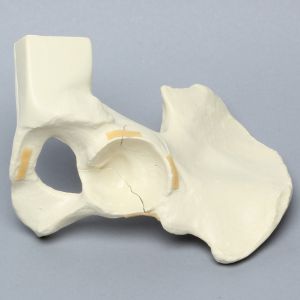 Hemi Pelvis with Wall Fractures, Solid Foam, Right