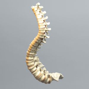 Spine, Scoliosis, T1-Sacrum with 15 degree Rotation, Solid Foam