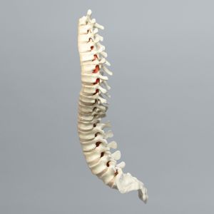 Spine, Scoliosis, T1-Sacrum with 25 Degree Rotation, Solid Foam