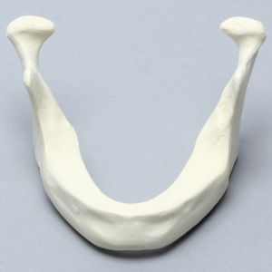 Mandible with Plateau Deformity