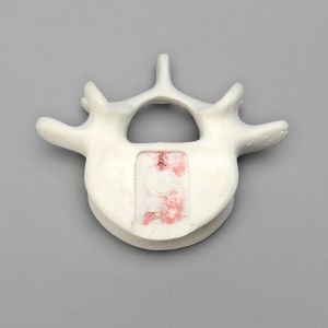 Vertebra, L5, Foam Cortical Shell, For Spinal Navigation