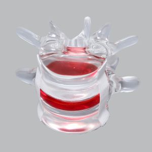 Lumbar Vertebrae L4-L5 with Gel-filled Nucleus, Solid Clear Plastic