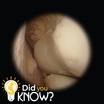 Did you know intra-articular loose bodies are one of the most common indications for surgery of the elbow?