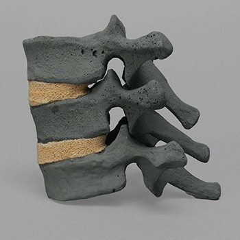 Osteoporotic bone models demonstrate key characteristics of an osteoporotic fracture