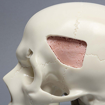 Skull with Fracture and Craniotomies